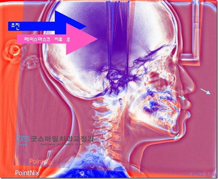 앞니 반대교합의 1차 교정치료 페이스마스크…