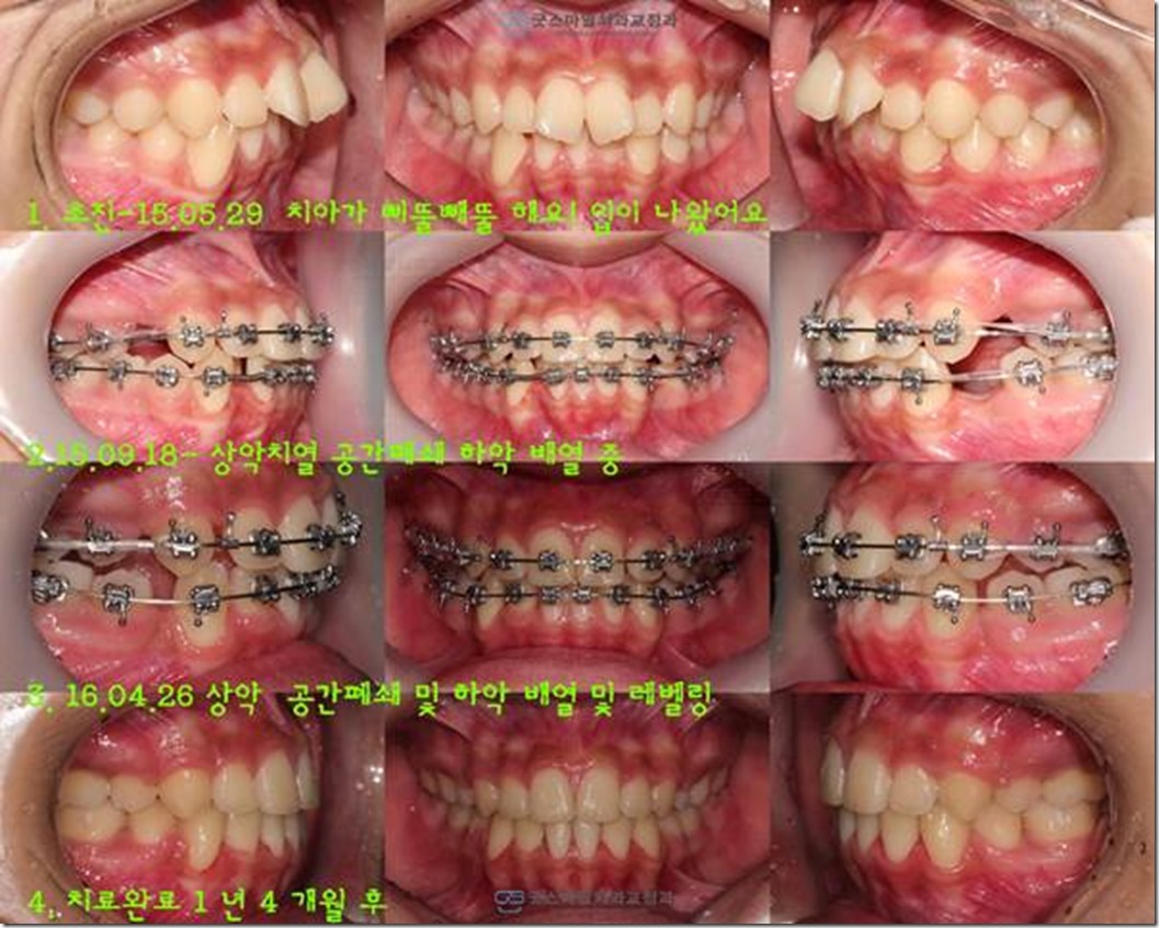 제1급 돌출입 부정교합 환자의 발치 교정치료