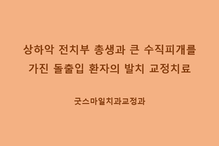 상하악 전치부 총생과 큰 수직피개를…