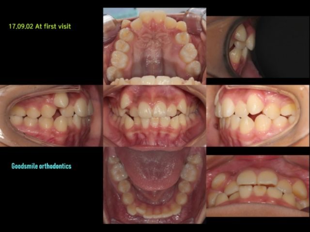 Upper 1st premolars Ext case…