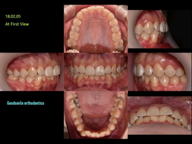 Lower total arch retraction Lower…