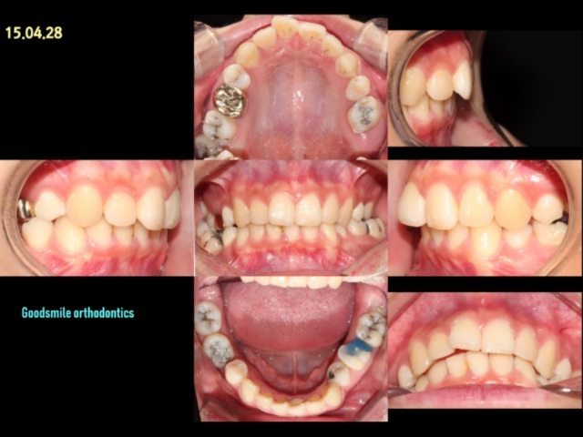 Molars protraction to constricted alveolar…