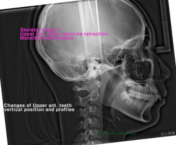 Treatment of lip protrusion patient…