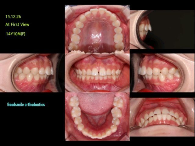 Treatment of lip protrusion patient…