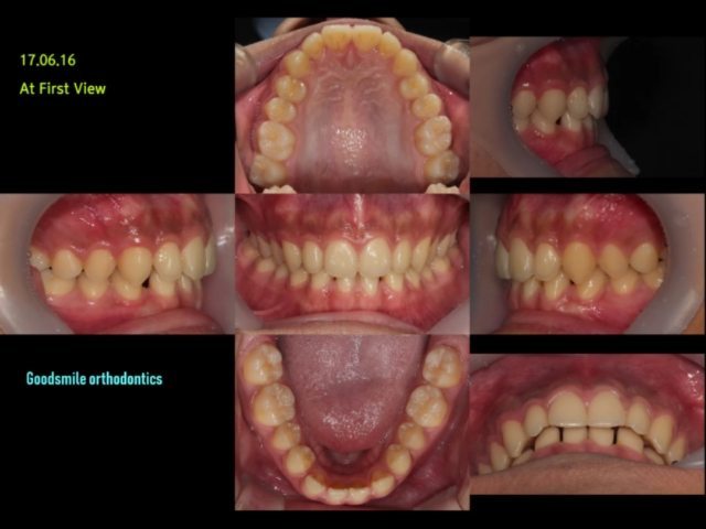 Camouflage Treatment of adult patient…