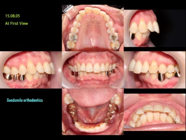 Orthognathic surgery-like Orthodontics This femal…