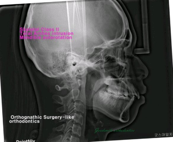 Skeletal class II, Dental class…