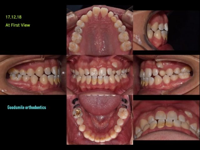 Treatment of skeletal class III…