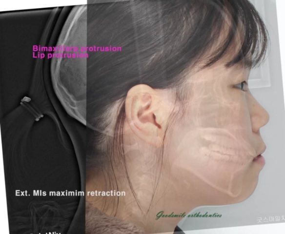 case report of Bimaxillary protrusion…