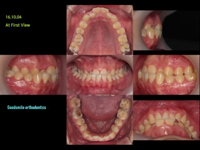 Camouflage treatment of severe mandibular…