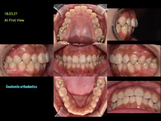 non-extraction treatment case of borderline…