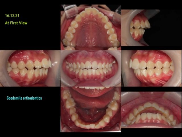 Case report – orthodontic camouflage…