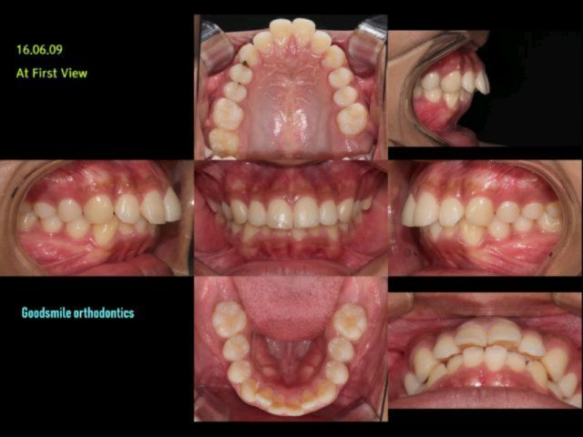 treatment of dental class II…