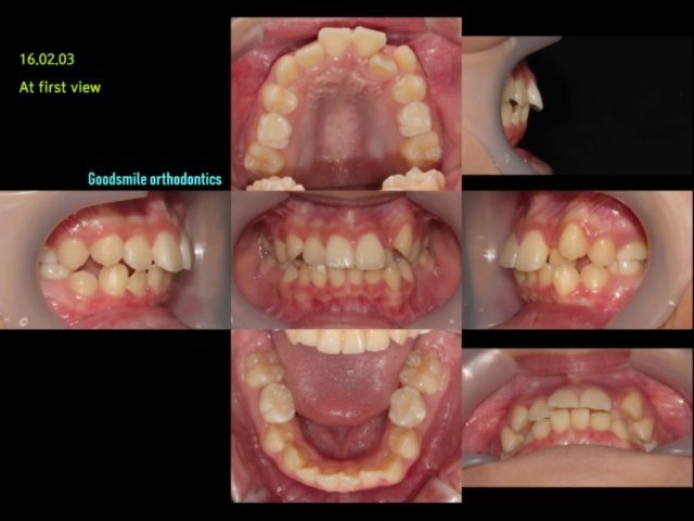 2nd phase treatment of Skeletal…