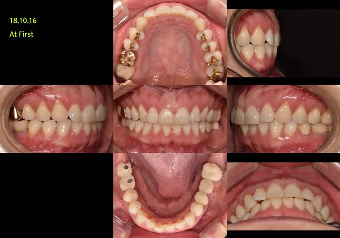 Simple lingual orthodontic camouflage treatment…