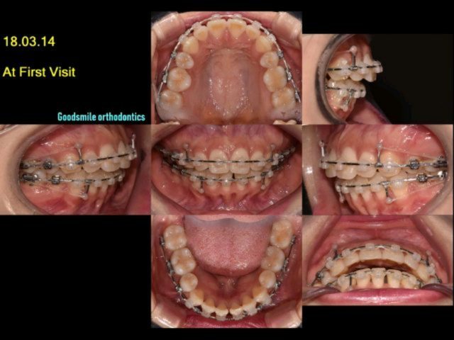 Re-treatment of Skeletodental dysplasia skeletal…