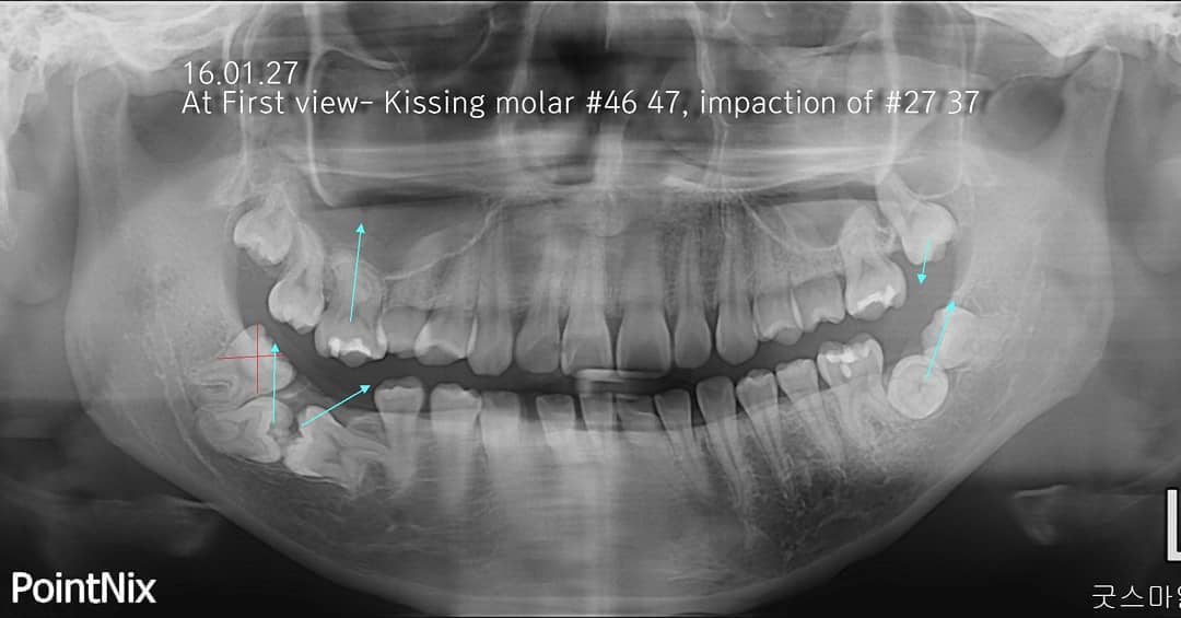 Mid treatment reassessment of kissing…