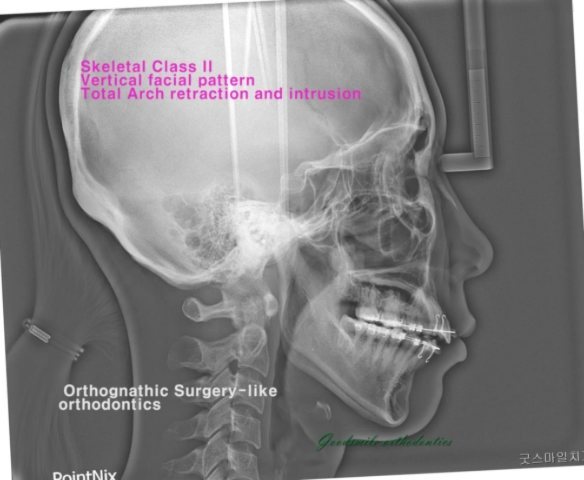 Re-treatment of Skeletodental dysplasia skeletal…