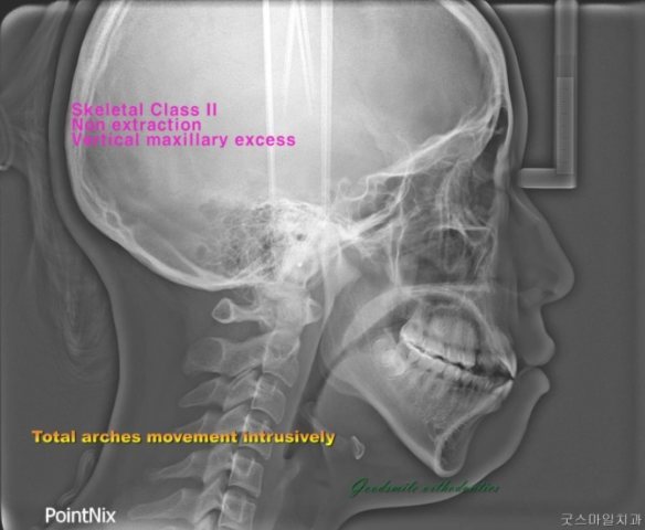 camouflage treatment of Vertical maxillary…