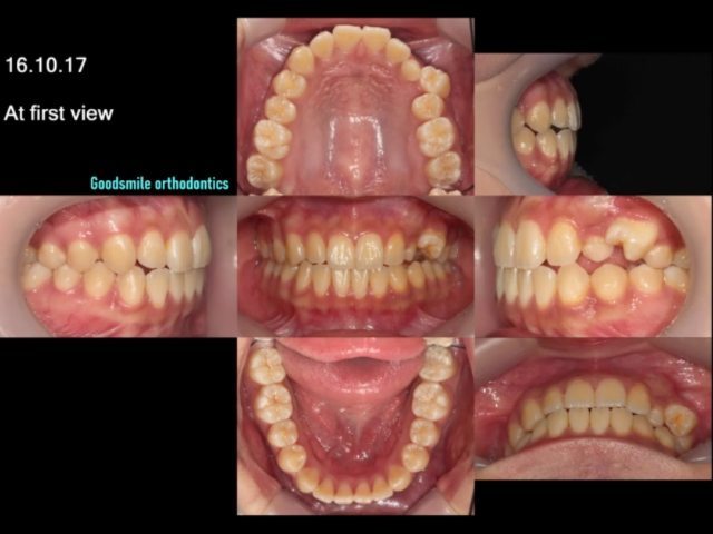 Orthodontic traction for #23 horizontally…