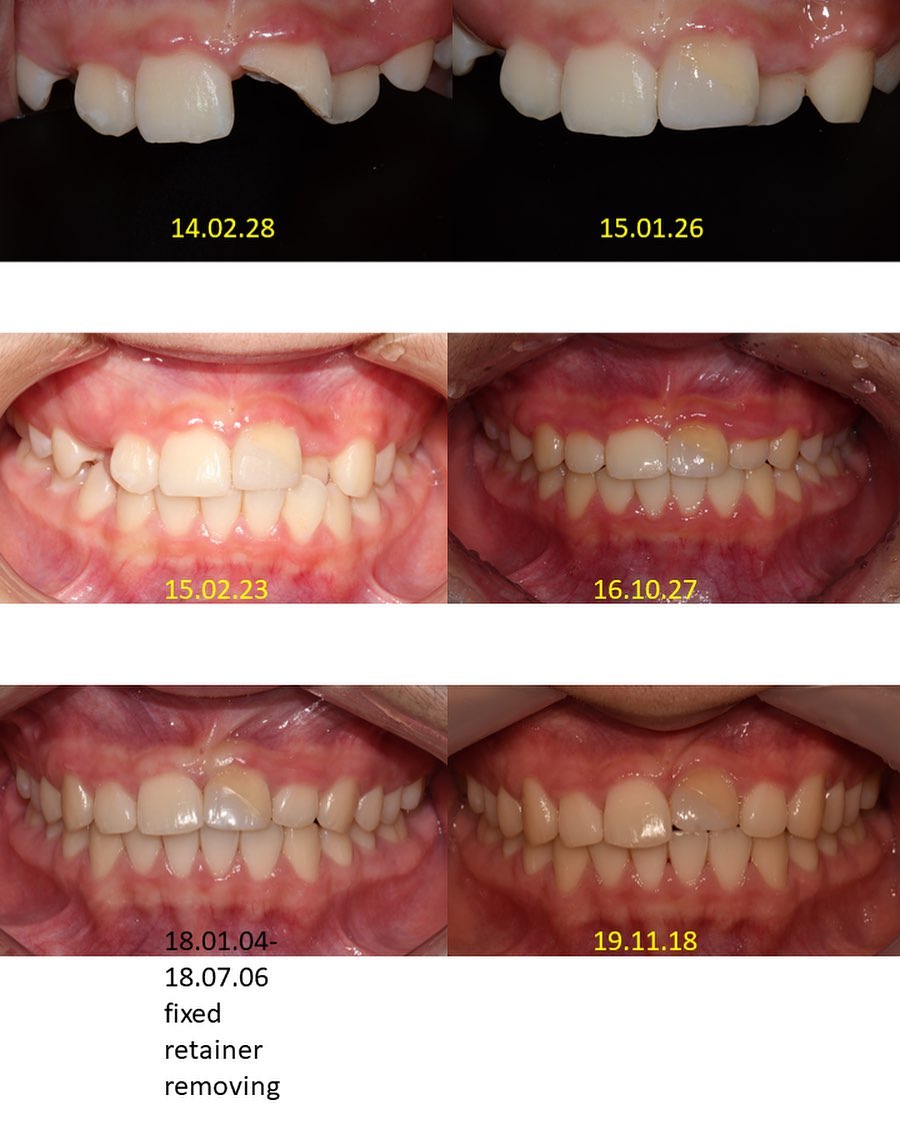 ankylosis tooth #blackshaqgoodsmile #ankylosis…