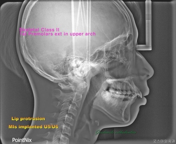 Camouflage treatment of skeletal class…