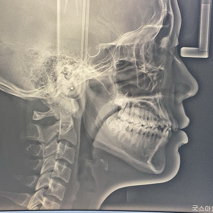 total arch retraction #blackshaqgoodsmile #orthod…