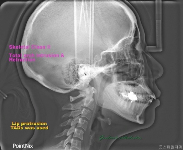 Non extraction Total arch movement…