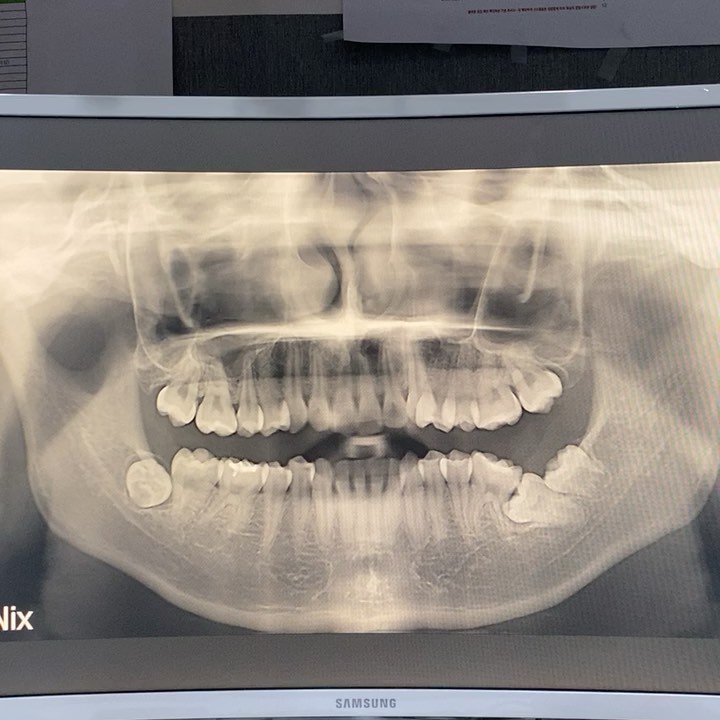 Treatment of horizontal impaction of…