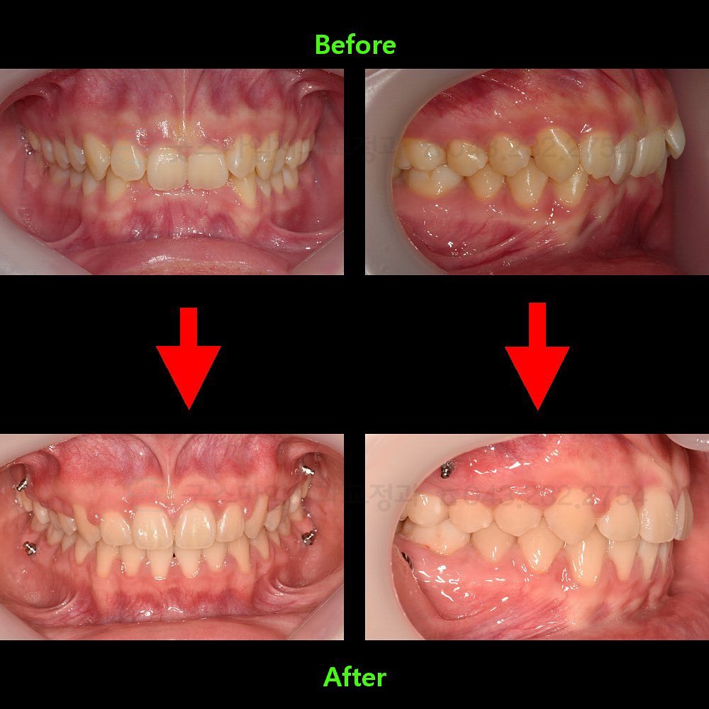 Treatment of dental severe deep…