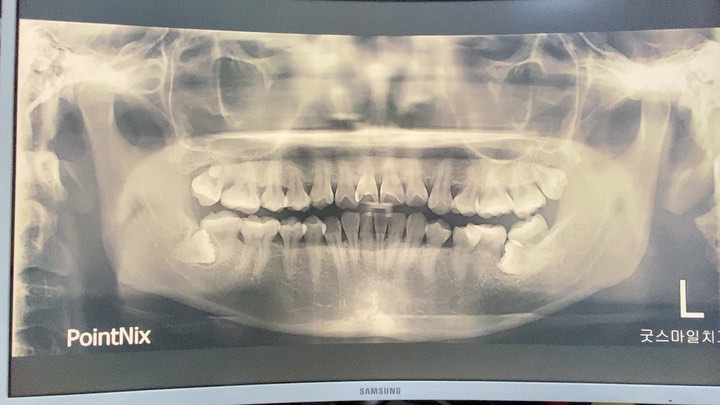 treatment of 2nd molar impaction…