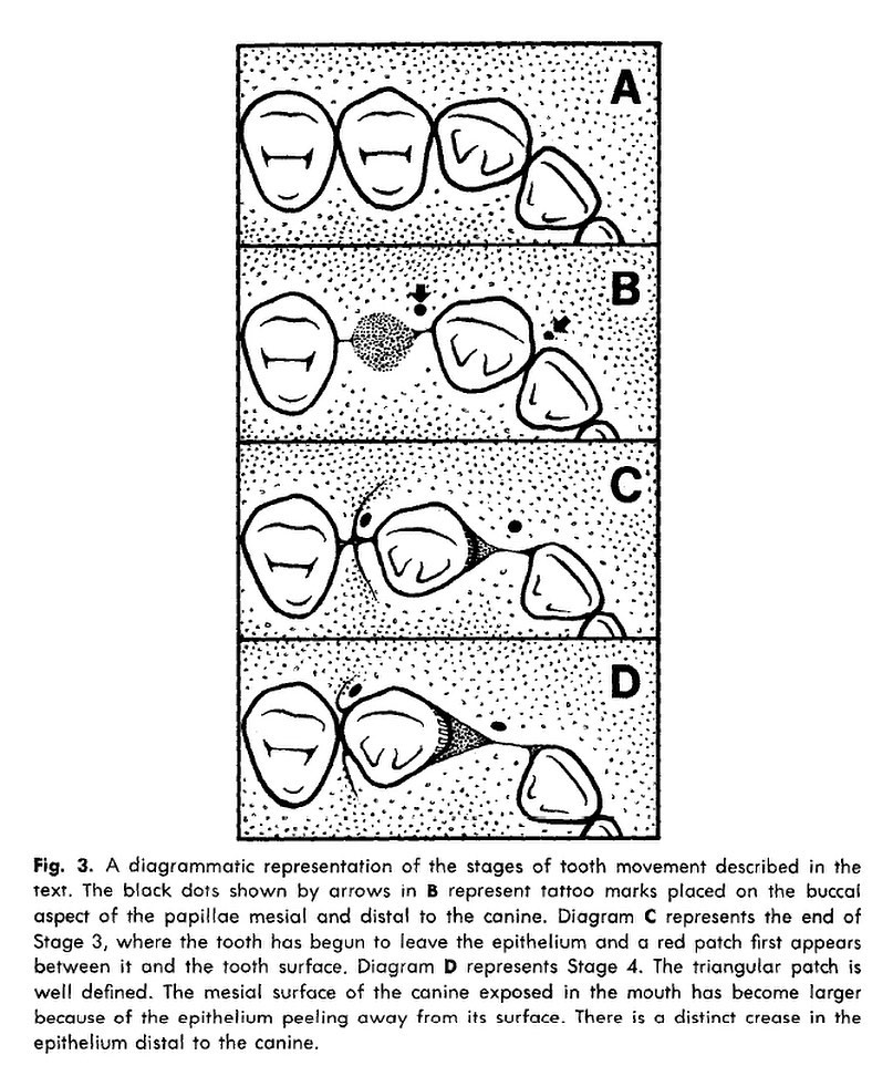 Atherton’s patch #orthodontics#blackshaqgoodsmile…