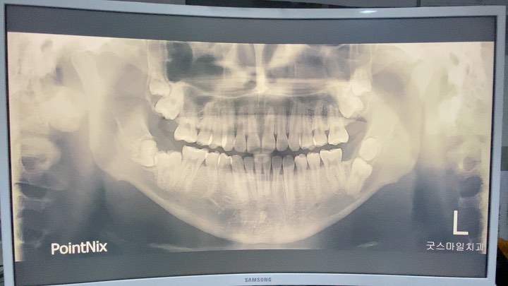 Treatment of 4 2nd molars…