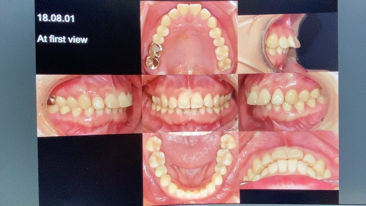 Treatment of dental Class II…