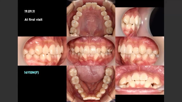 Camouflage treatment of dental Class…