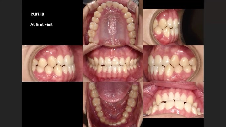 Mandibular total arch distalization to…