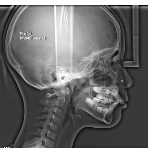 2 phase treatment of skeletal…