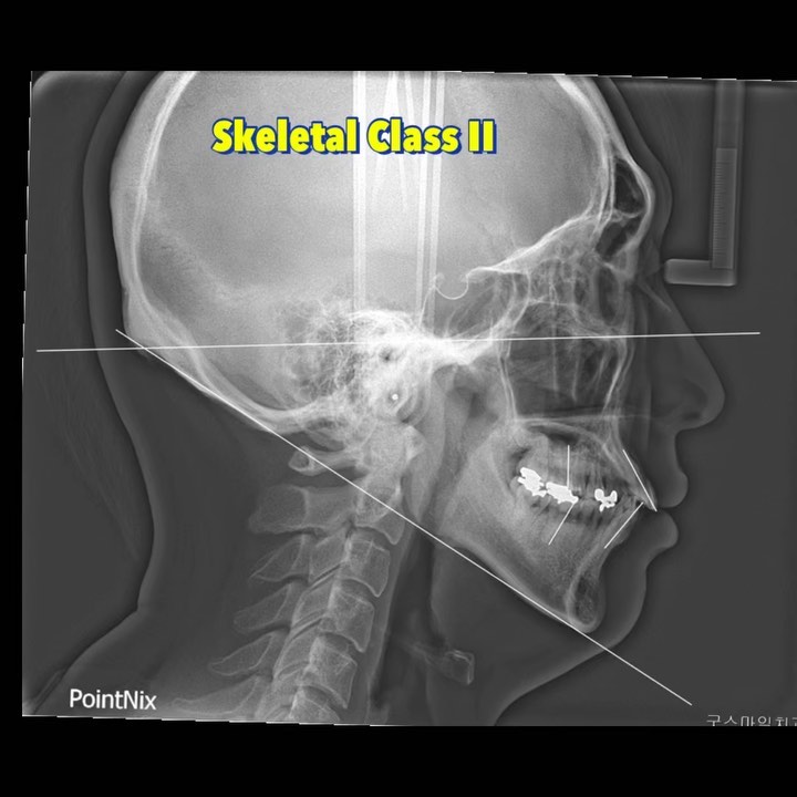 Treatment of skeletal Class II…