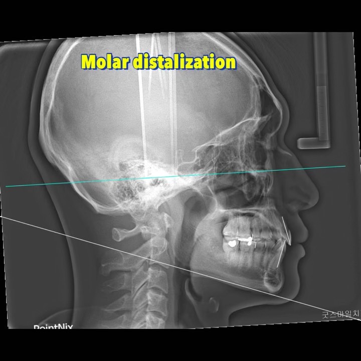 molar distalization to correct moderate…