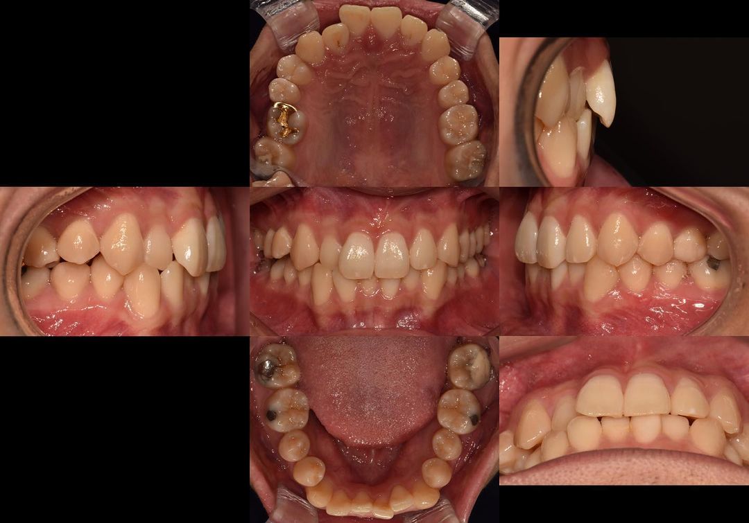 Correction of severe anterior crowding…