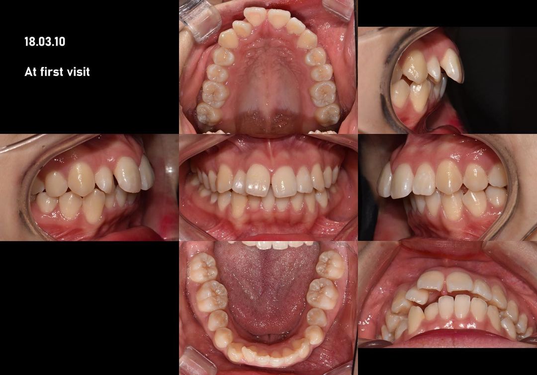 Camouflage treatment of skeletal Class II, mandibu - 굿스마일포럼