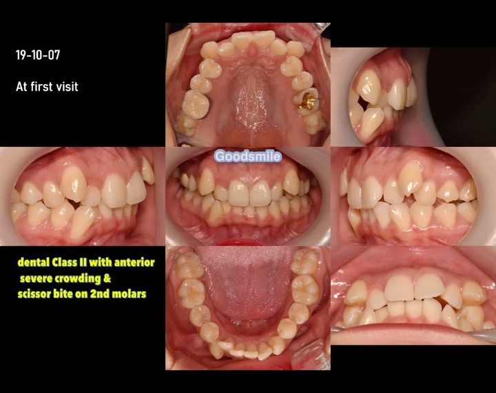 Correction of dental Class II…