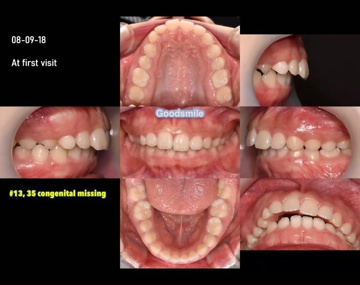 Treatment of skeletal Class II…