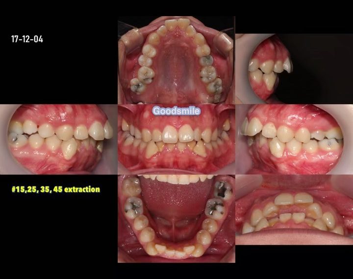 Treatment of skeletal Class II…