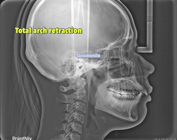 Treatment of dental Class II…