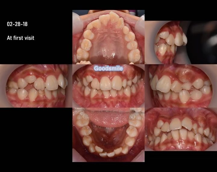 Treatment of skeletal Class III…