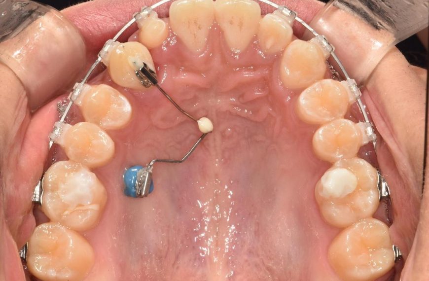 To correct inclination of impacted canine by using…