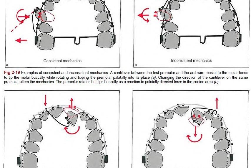 consistent vs inconsistent force system #biomecha…