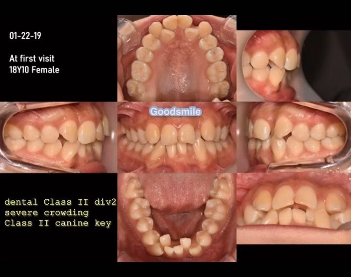 Treatment of skeletal Class III, dental Class II w…