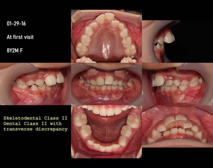 2-Phase treatment of skeletal Class II, dental Cla…